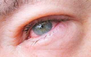 Почему возникает блефароконъюнктивит глаз и его лечение в домашних условиях?