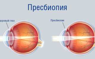 Поставили диагноз пресбиопия глаза: что это такое у взрослых, методы коррекции