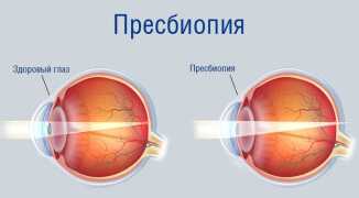 Поставили диагноз пресбиопия глаза: что это такое у взрослых, методы коррекции