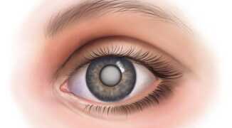 Вам поставлен диагноз катаракта? Операция — самый эффективный способ лечения