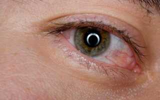 Идем в аптеку: какие противовирусные глазные капли наиболее эффективны