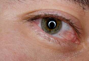 Идем в аптеку: какие противовирусные глазные капли наиболее эффективны