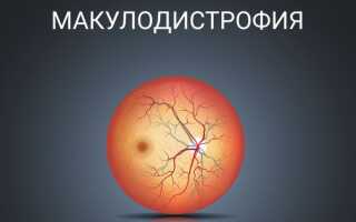 Что такое макулодистрофия сетчатки глаза? Лечение современными методами