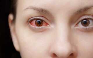 Как лечить красные глаза при простуде?