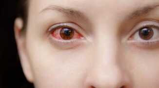 Как лечить красные глаза при простуде?