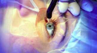 Операции на глаза: лазерная коррекция зрения