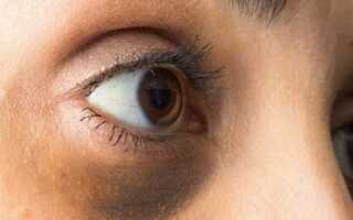 5 советов: как выбрать лучшее средство от синяков под глазами