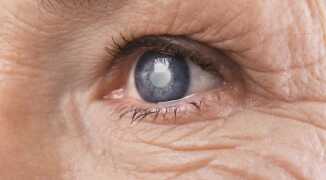 Как сохранить зрение: почему развивается начальная катаракта и как ее предотвратить