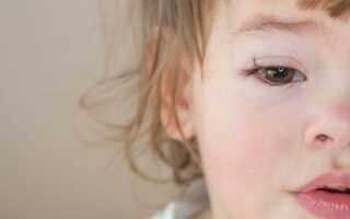  В помощь маме: у ребенка опух глаз, как помочь малышу?
