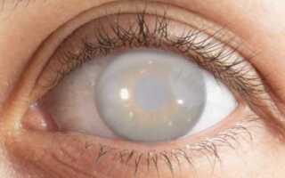 Почему возникает осложнённая катаракта и как этого не допустить?
