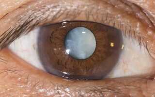 Об операциях на глаза на чистоту: факоэмульсификация катаракты