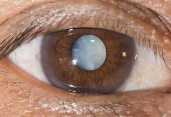 Об операциях на глаза на чистоту: факоэмульсификация катаракты