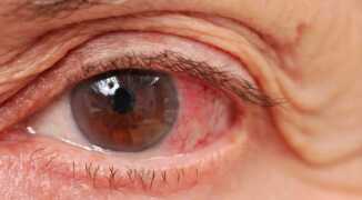 Что такое терминальная глаукома? Нужна ли операция при болевой форме заболевания?