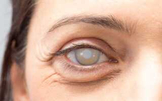 Какие виды катаракты выделяют врачи?