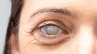 Какие виды катаракты выделяют врачи?