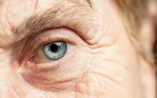 Как формируется зрелая катаракта?