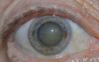 Как лечится незрелая катаракта? Можно ли обойтись без операции?