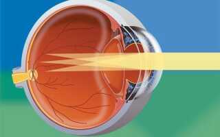Как победить гиперметропический астигматизм: два способа вернуть зрение без операции