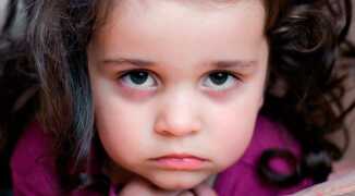  В помощь маме: почему появляются красные круги под глазами у ребенка?