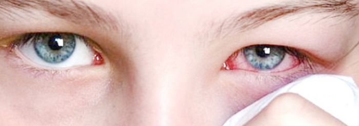 Красные опухшие глаза лечение