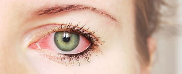 Зуд покраснение глаз отек лечение