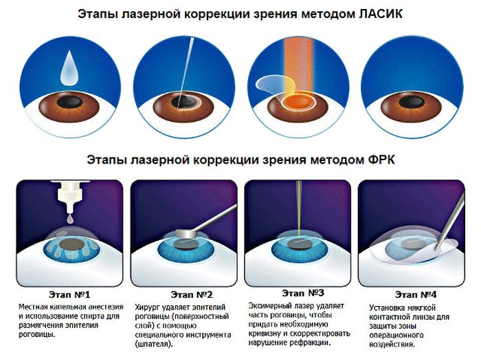 Этапы лазерной коррекции зрения методами ЛАСИК и ФРК