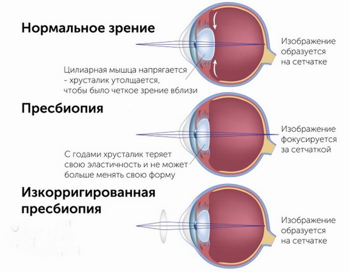 Пресбиопия (возрастное снижение зрения)