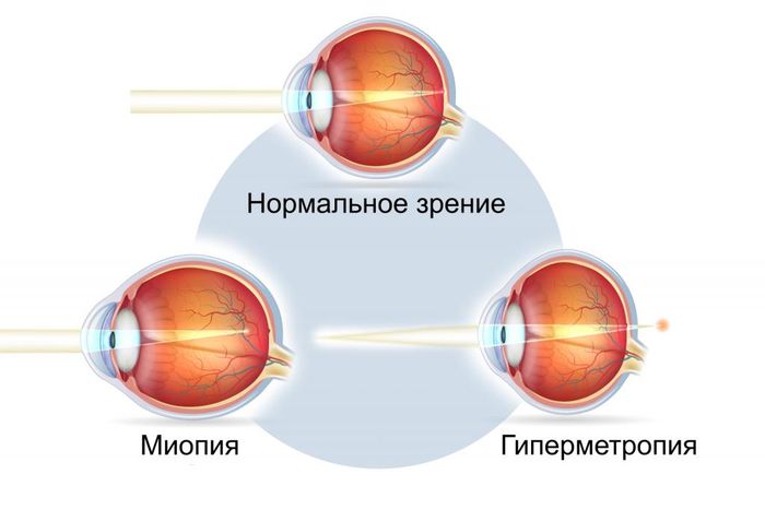 Заболевание глаз миопия