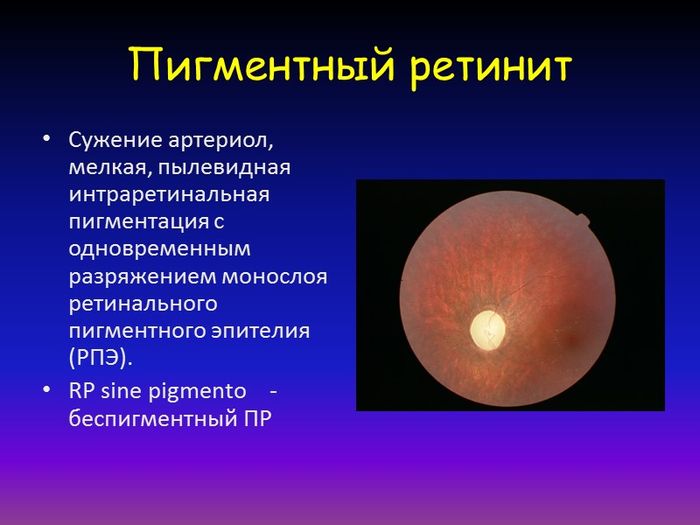 Описание болезни глаза