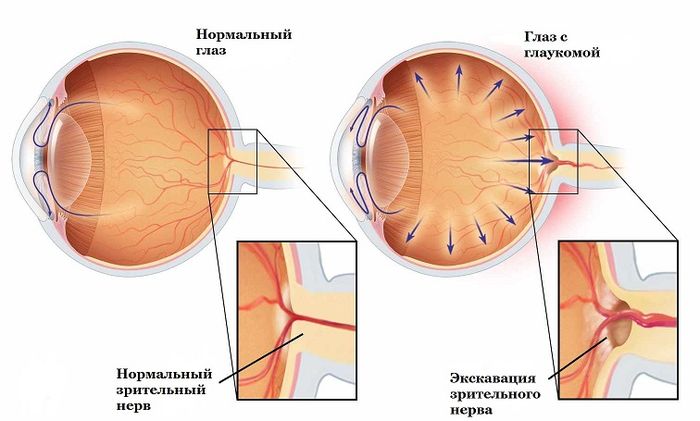 Глаукома - заболевание глаз