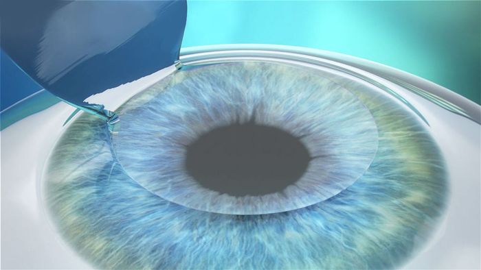 Лазерная операция на глаз 