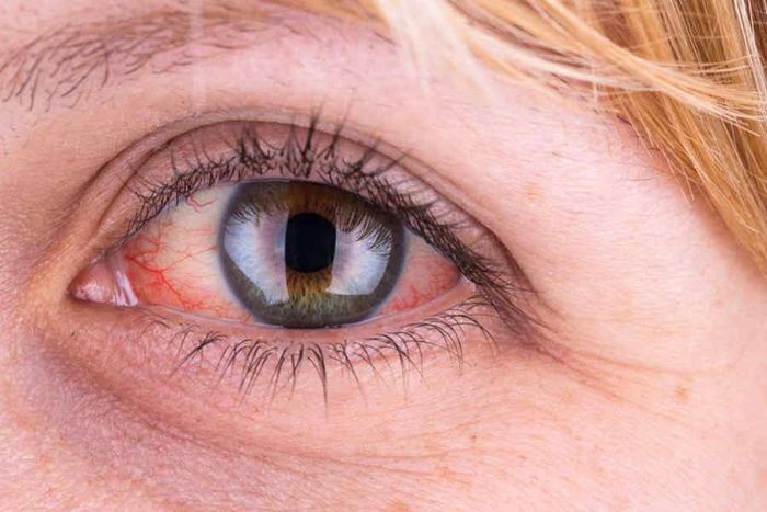 Заболевание глаз кератит
