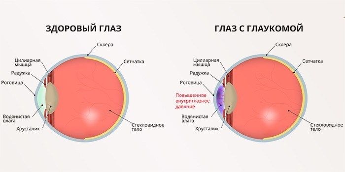 Нормальный глаз и глаз с глаукомой