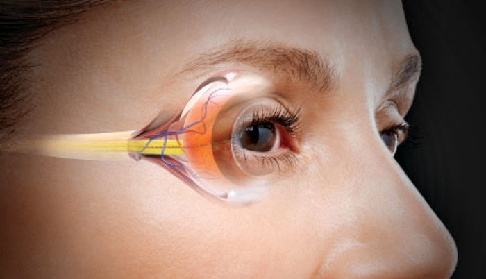Заболевание глаз глаукома