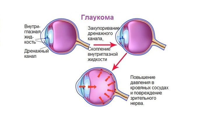 Глаз при глаукоме