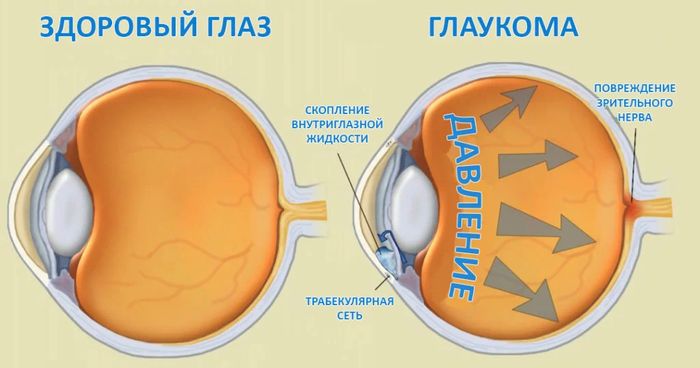 Здоровый глаз и при глаукоме