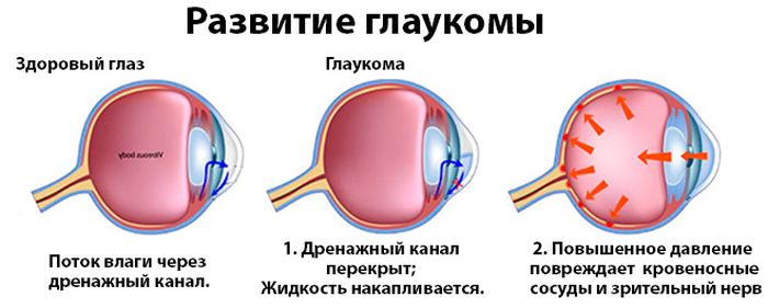 Развитие глаукомы