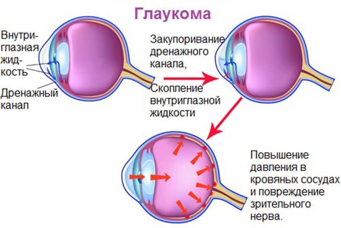 Глаукома заболевание