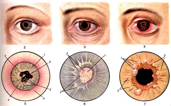 Заболевания радужной оболочки глаза