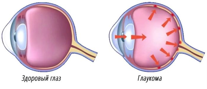 Здоровый глаз и при глаукоме