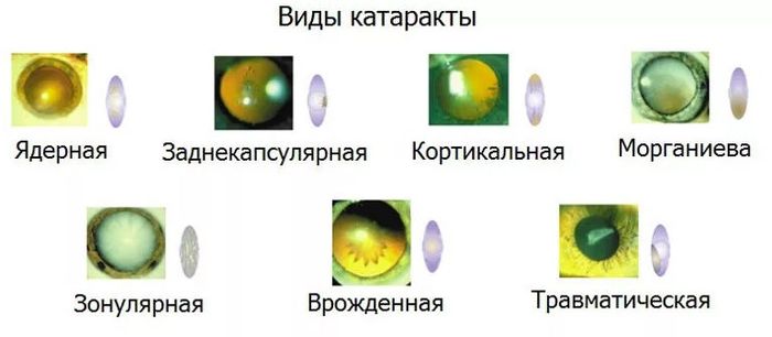 Разновидности катаракты