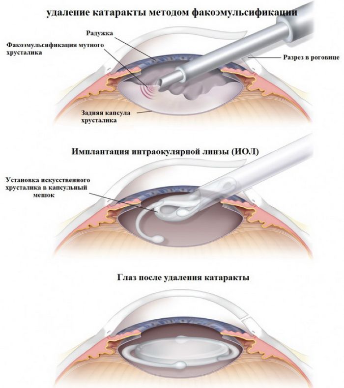 Удаление катаракты