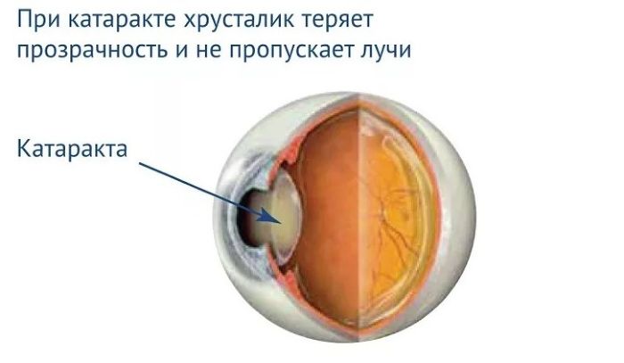 Хрусталик глаза при катаракте