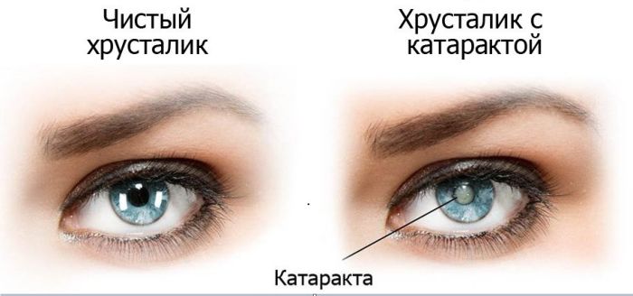 Глаз с катарактой