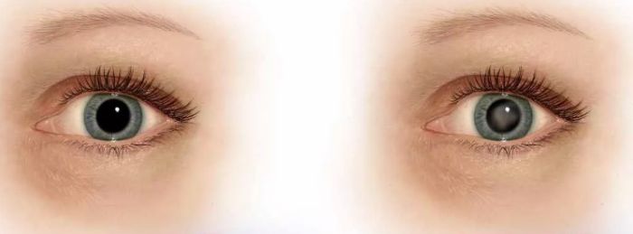 Заболевание хрусталика глаза-катаракта