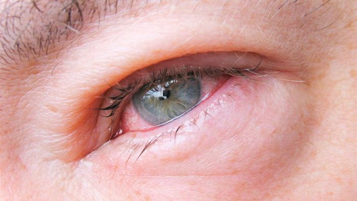 Глаз с блефароконъюнктивитом