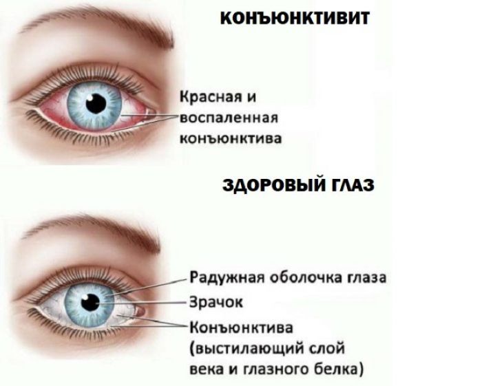 Здоровый глаз и глаз с коньюктивитом
