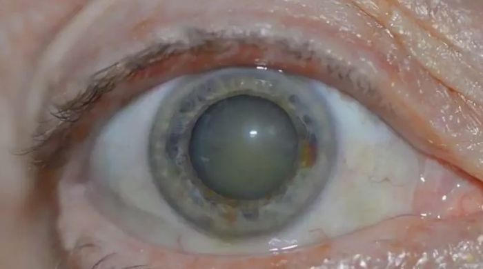 Глаз с катарактой