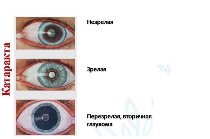Формы катаракты