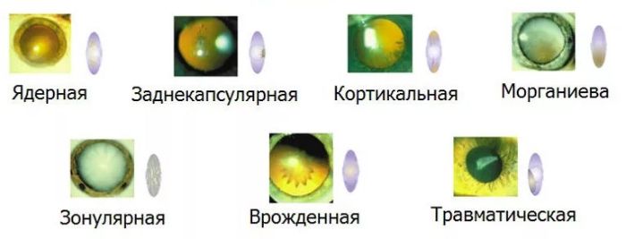 Типы катаракты